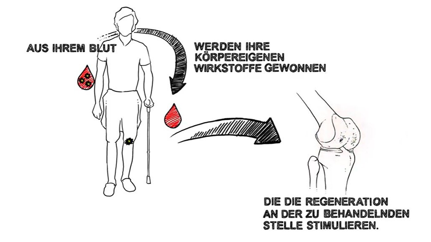 Darstellung der ACP-Eigenbluttherapie.